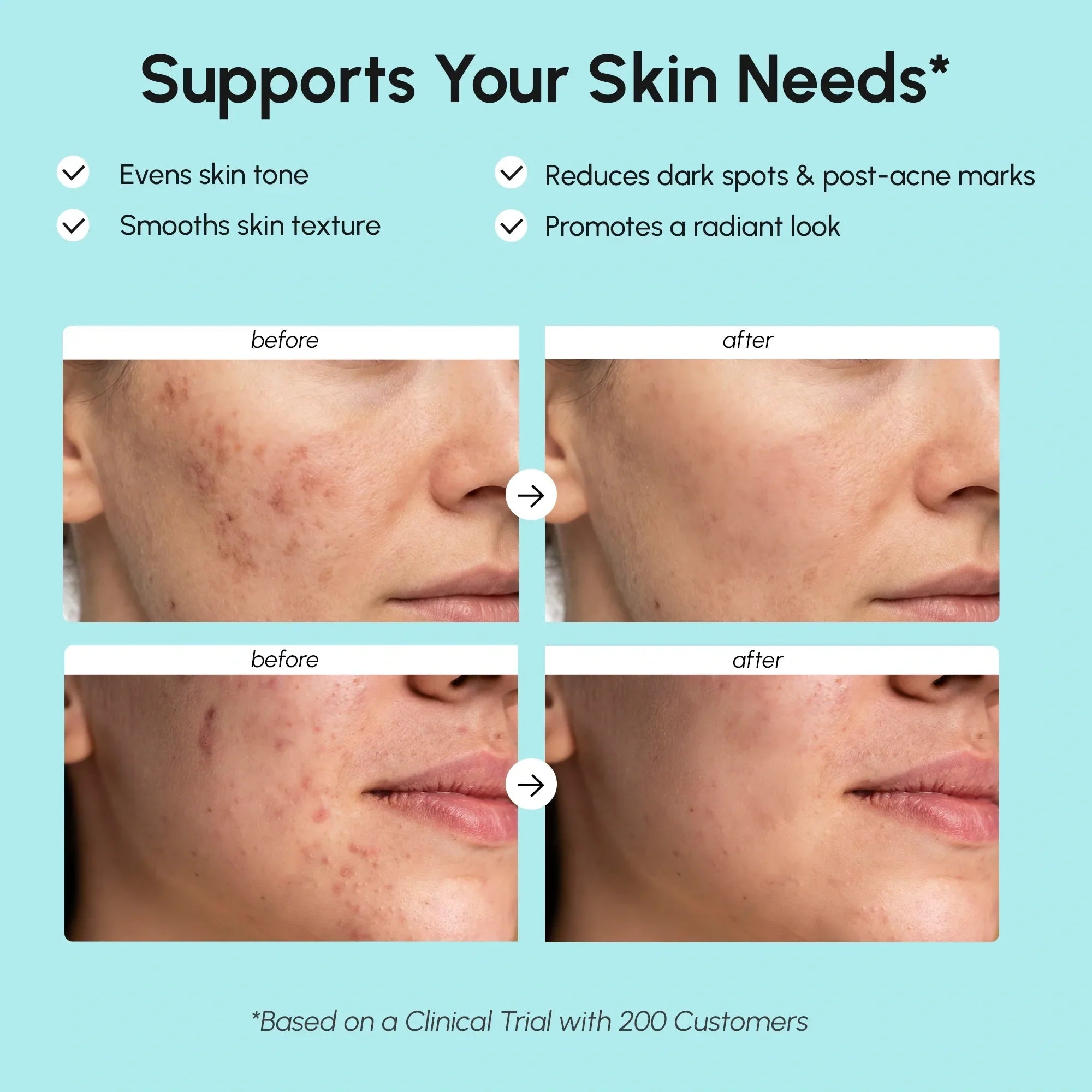 Azelaic Acid Cream for Sensitive Skin - SNMShop