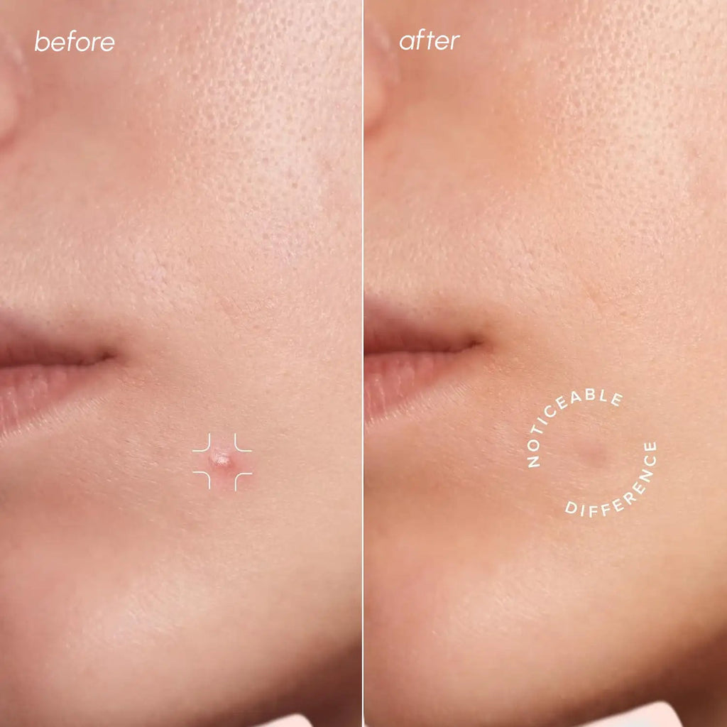 Invisible Pimple & Acne Patches - SNMShop