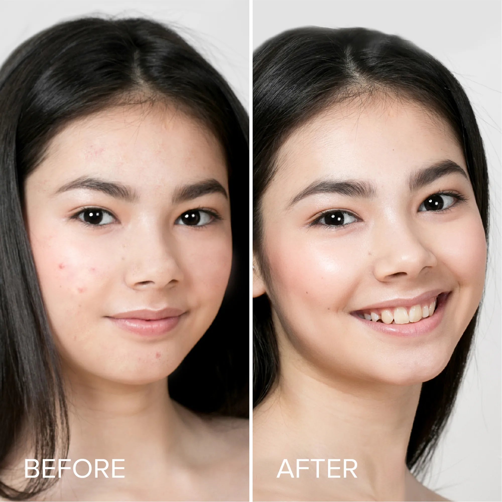Pimple & Acne Patches - SNMShop
