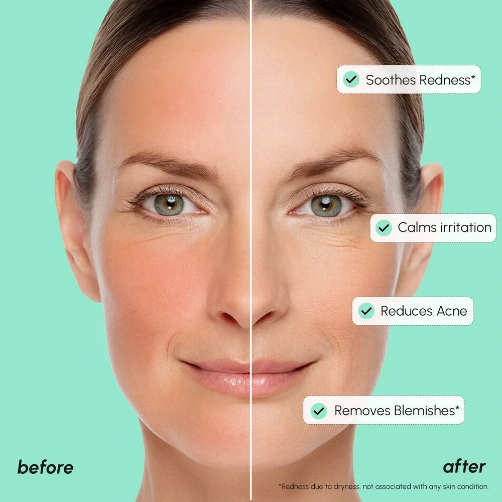 Redness Soothing Azelaic Acid Serum - SNMShop