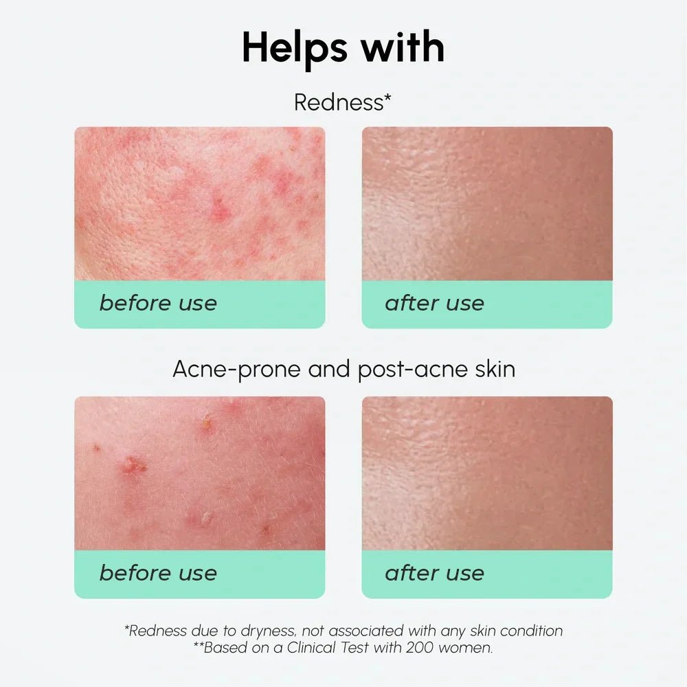 Redness Soothing Azelaic Acid Serum - SNMShop